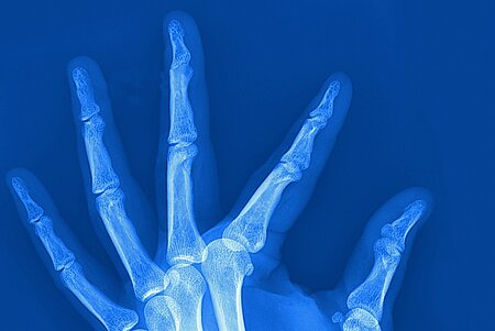 Blue X-ray image of a left hand.