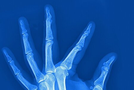 Blue X-ray image of a left hand.