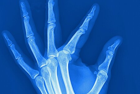 Blaues Röntgenbild von einer linken Hand